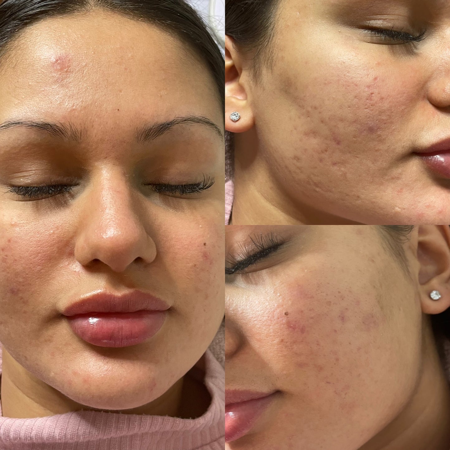 Biomicroneedling Schulung Workshop