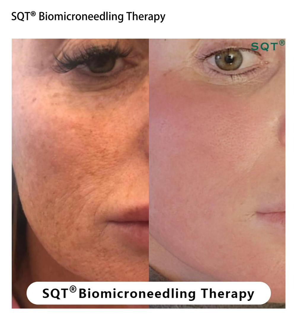 Biomicroneedling Schulung Workshop