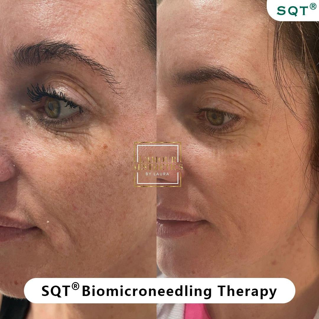 Biomicroneedling Schulung Workshop