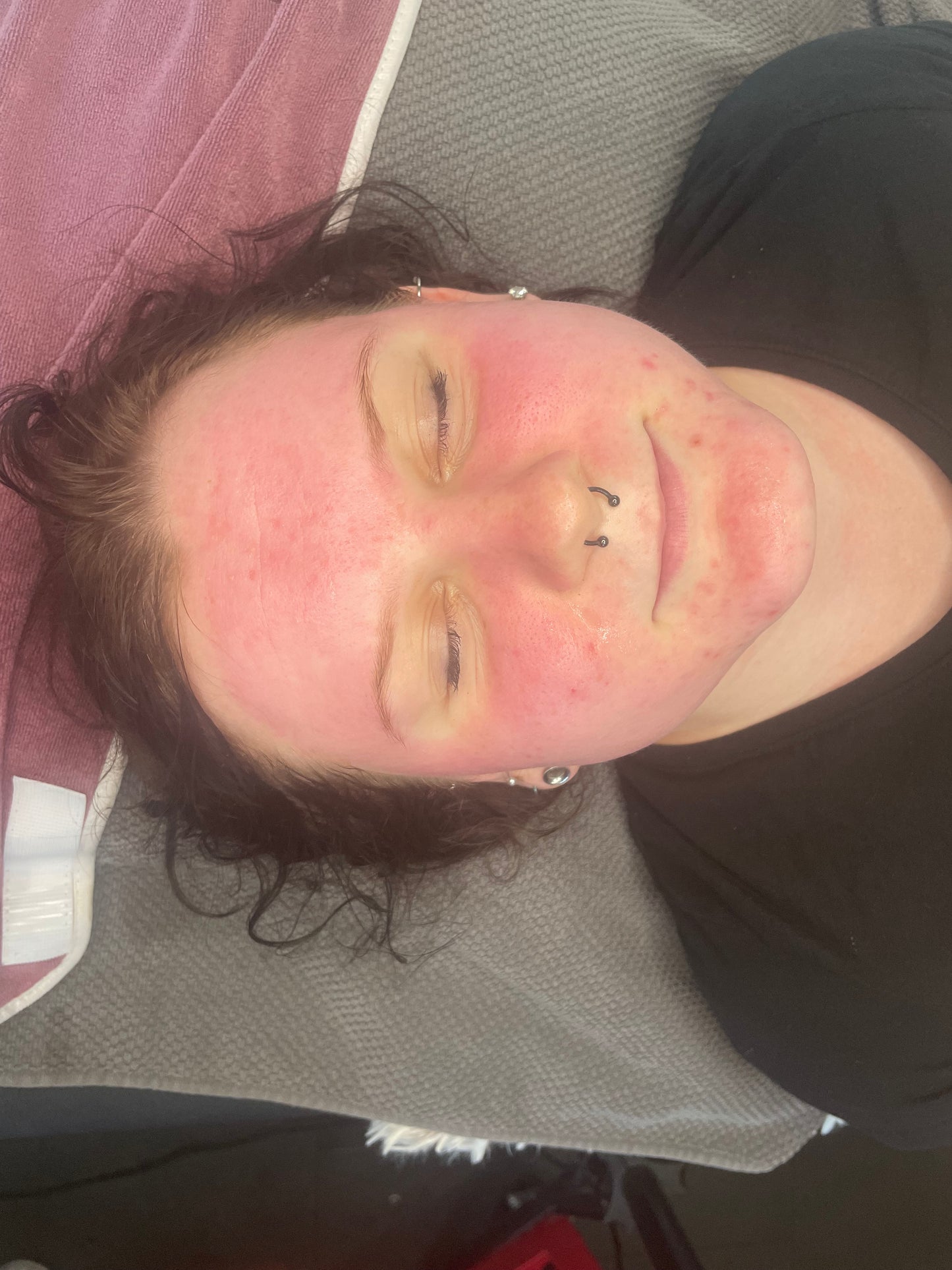Biomicroneedling Schulung Workshop