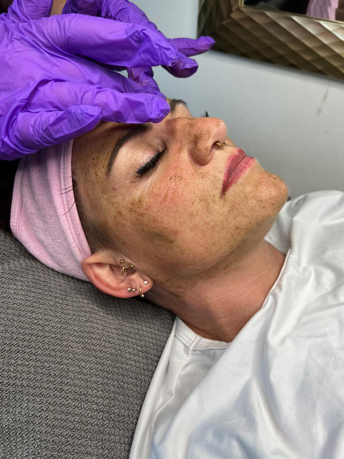 Biomicroneedling Schulung Workshop