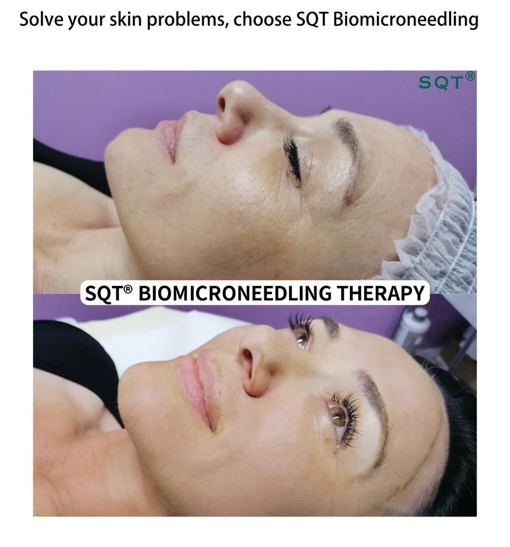 Biomicroneedling Schulung Workshop