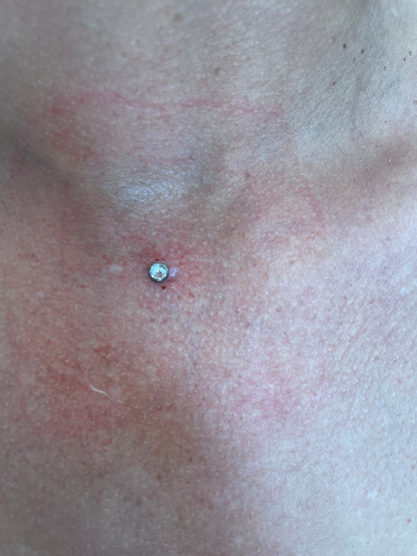Dermal Anchor Schulung 1Tag