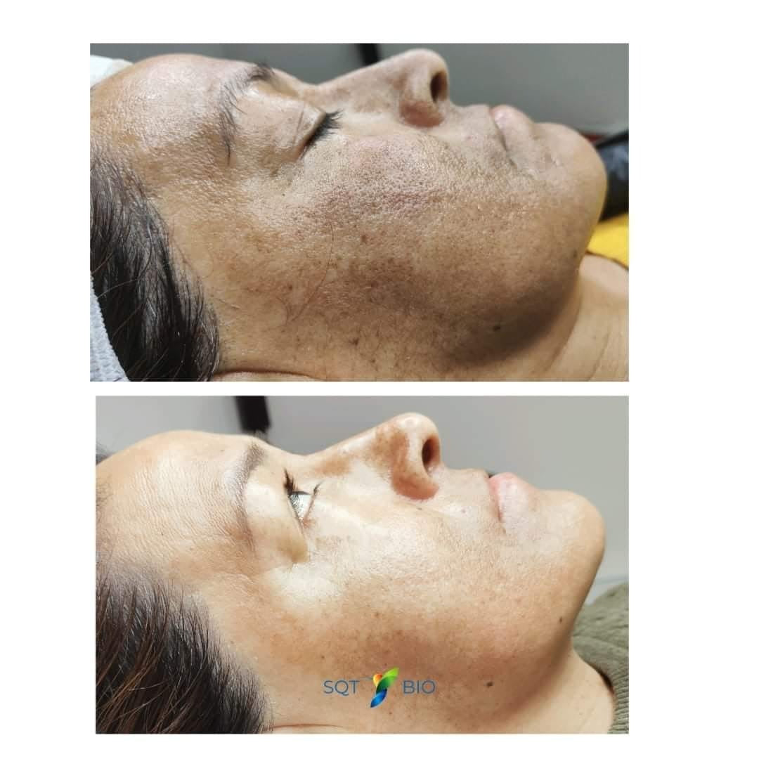 Biomicroneedling Schulung Workshop