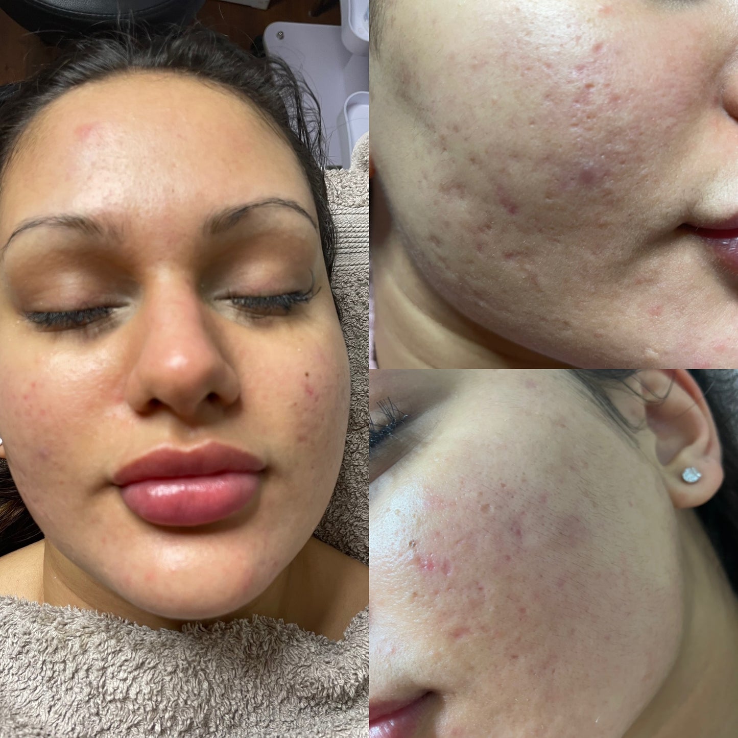 Biomicroneedling Schulung Workshop