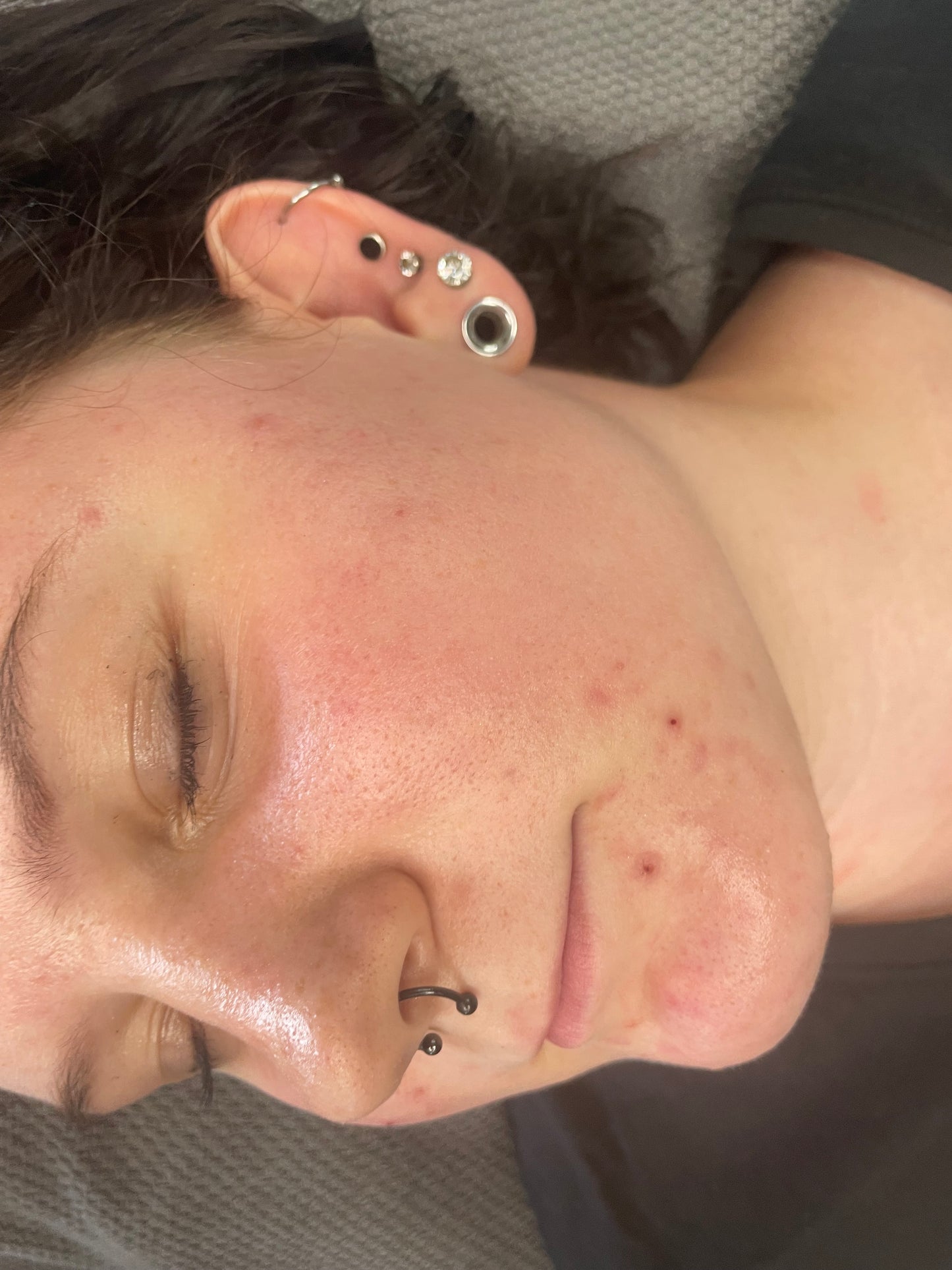 Biomicroneedling Schulung Workshop