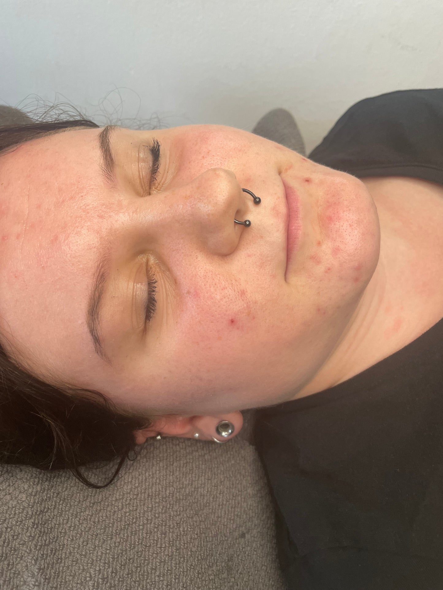 Biomicroneedling Schulung Workshop